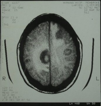 brain Scan with tumors