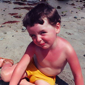 boy with bad sunburn
